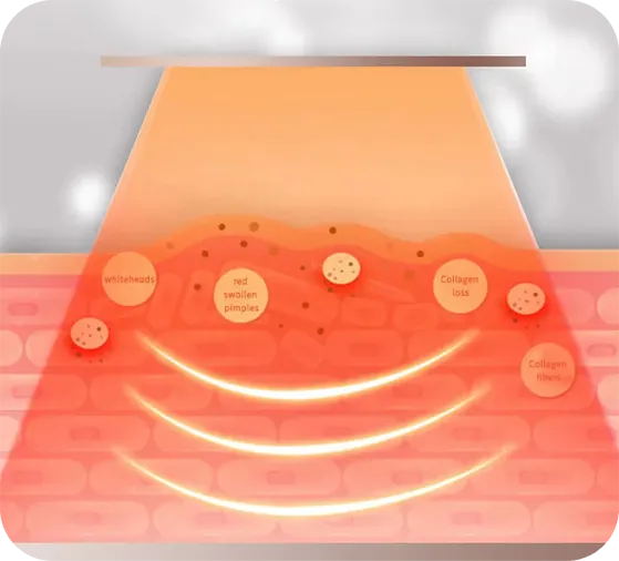 Glokore LED mask results before and after